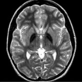 Axial T2WI MR shows symmetric hypointensity within the GP  . The eye of the tiger sign is absent; therefore, this is not PKAN. These findings are characteristic of NBIA.