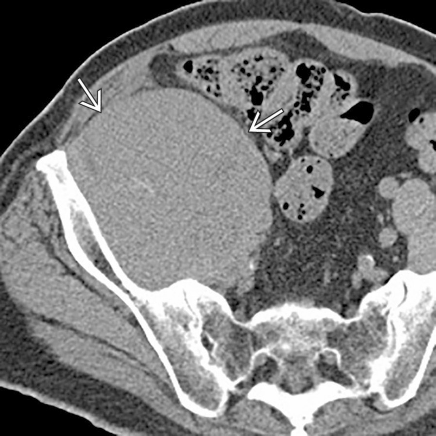 Axial CECT shows a large, homogeneous soft tissue mass  involving the right psoas and iliopsoas musculature. There were multiple enlarged lymph nodes elsewhere (not shown), and this was found to represent non-Hodgkin lymphoma.