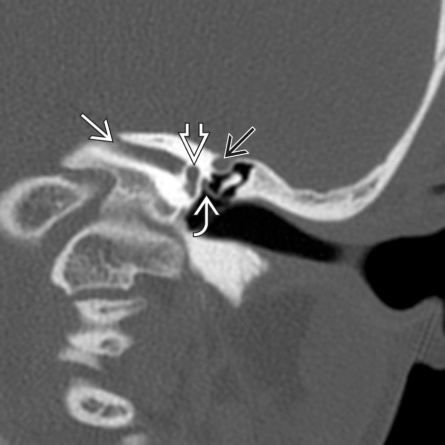 Coronal bone CT reformat in a 7-year-old girl with CHD7 mutation shows a small IAC , diminutive vestibule , and absent SCC. Facial nerve canal  overlies the atretic oval window with fusion to malformed stapes. There is an emissary vein indenting the tegmen tympani .