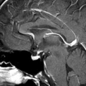 Sagittal T1 C+ FS MR in a 50-year-old patient with diabetes insipidus shows focal enlargement of the pituitary infundibulum  related to lymphocytic infundibuloneurohypophysitis.