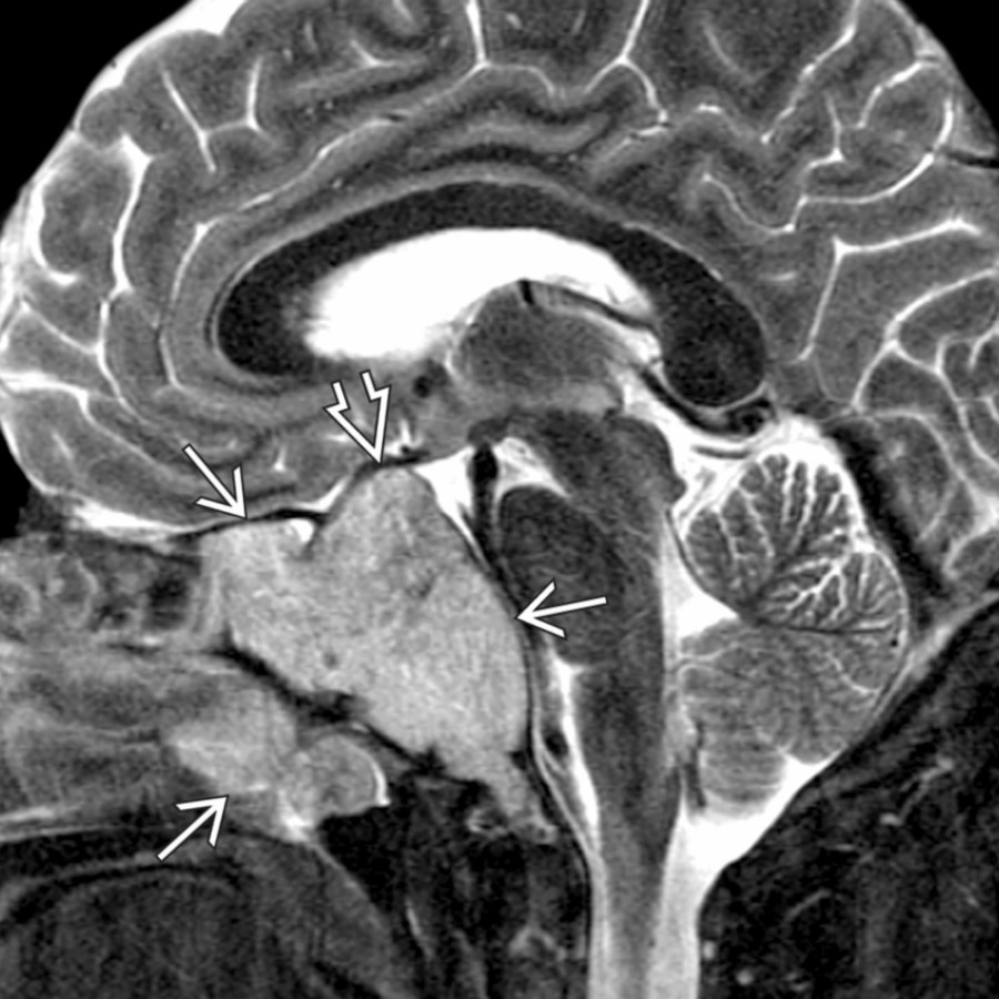 Sagittal T2 MR shows a hyperintense extensively invasive mass . The pituitary gland  cannot be identified separately from the lesion in this male patient with elevated prolactin and an invasive macroadenoma.