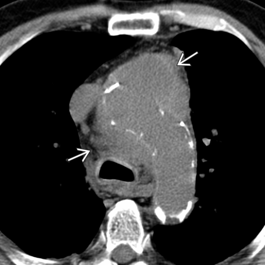 Axial NECT of the chest in a patient with PAU at the aortic arch with aortic rupture shows an anterior mediastinal mass due to mediastinal hematoma , indicating rupture. Note that PAU can simulate the presence of an anterior mediastinal mass, and contrast remains critical for appropriate differentiation.