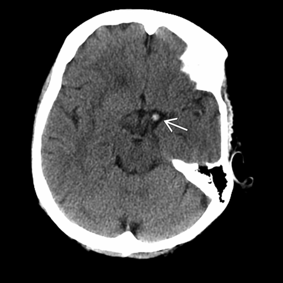 NECT in a 52-year-old man presenting with acute-onset right hemiplegia, aphasia, and neglect demonstrates dense left internal carotid artery (ICA) terminus .