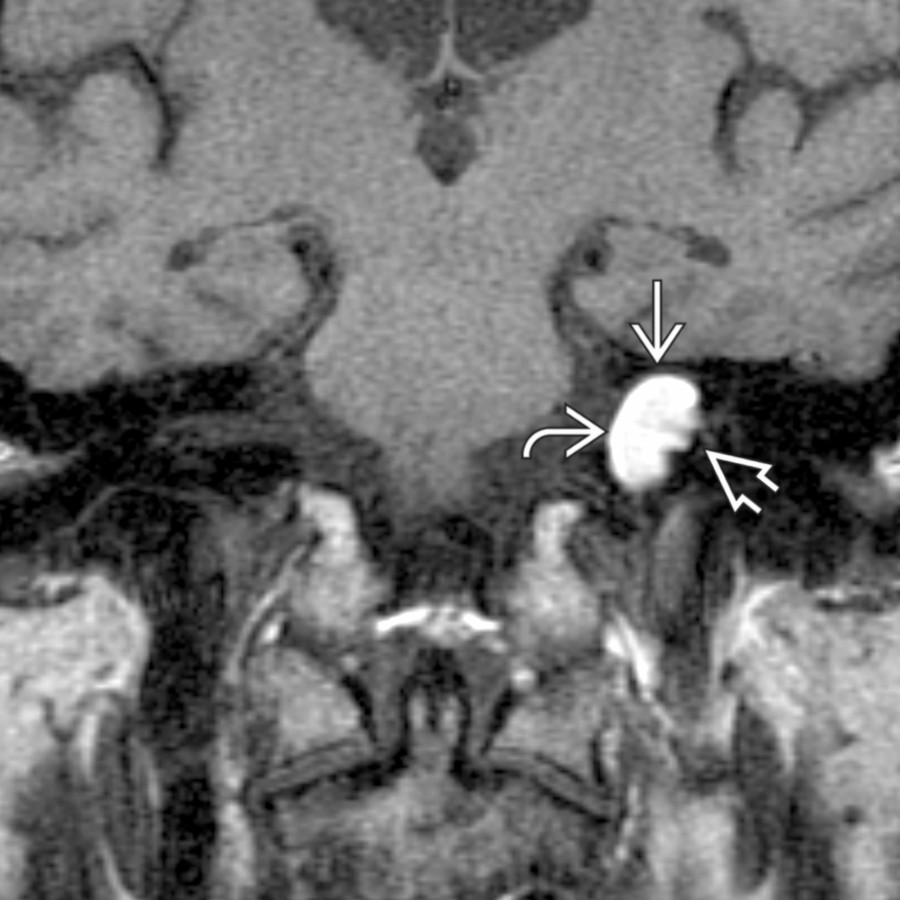 Coronal T1 MR of a left CPA-IAC lipoma shows a T1-bright lobular mass  extending into the IAC . The presence of chemical shift artifact  at the tumor-CSF (i.e., water) margin confirms the presence of fat within this mass.