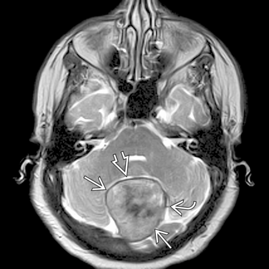 Axial T2WI MR demonstrates a posterior fossa meningioma  with significant mass effect upon the cerebellum with interposed trapped CSF clefts  and vessels .