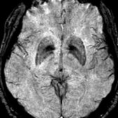 Axial T2* SWI MR demonstrates hypointensity in the lentiform nuclei, particularly related to the globus pallidi .