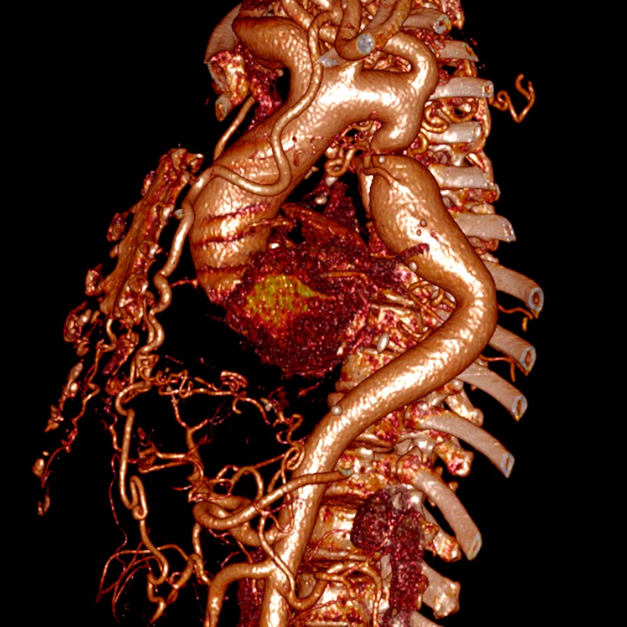 Volume-rendered 3D CTA in a patient with aortic coarctation allows for morphologic assessment of the coarctation and provides an overall appreciation of the extent of collateralization. 3D reformations are most helpful for clinicians/surgeons to get the overall picture of the 3D configuration of the pathology.