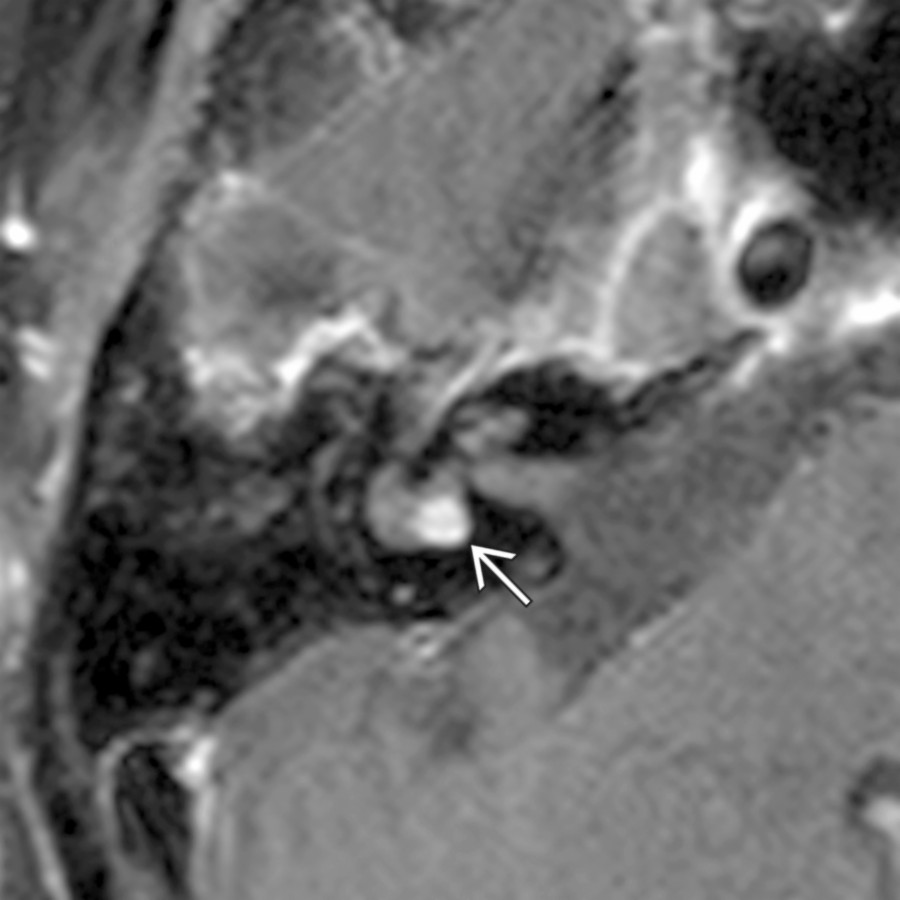 Axial T1 C+ FS MR demonstrates a nodule of enhancing tissue in the vestibule  of the inner ear secondary to intralabyrinthine schwannoma. CT of the T-bone was normal.