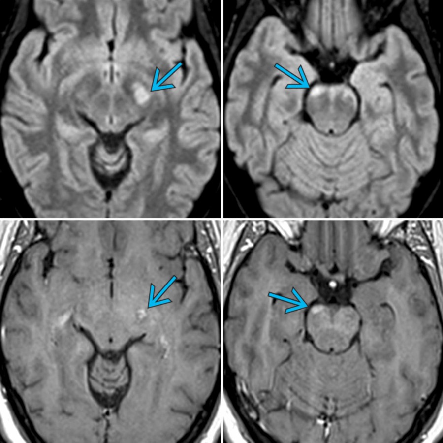 Axial FLAIR MR (top) and T1 C+ MR (bottom) images in the same patient show hyperintense enhancing lesions    along the cerebral peduncles. AQP4 antibody was positive in this patient with NMOSD. Brain lesions in NMOSD typically involve the deep white matter, periependymal regions, corpus callosum, corticospinal tracts, brainstem, and cerebellum.