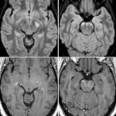 Axial FLAIR MR (top) and T1 C+ MR (bottom) images in the same patient show hyperintense enhancing lesions    along the cerebral peduncles. AQP4 antibody was positive in this patient with NMOSD. Brain lesions in NMOSD typically involve the deep white matter, periependymal regions, corpus callosum, corticospinal tracts, brainstem, and cerebellum.