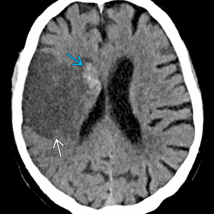 Axial CT at 3 days after initial onset of weakness and speech difficulties shows the classic appearance of an early subacute cerebral infarct. Note the wedge-shaped, low-density area  involving both the gray and white matter in the MCA distribution with blood products    in the right basal ganglia.