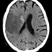 Axial CT at 3 days after initial onset of weakness and speech difficulties shows the classic appearance of an early subacute cerebral infarct. Note the wedge-shaped, low-density area  involving both the gray and white matter in the MCA distribution with blood products    in the right basal ganglia.