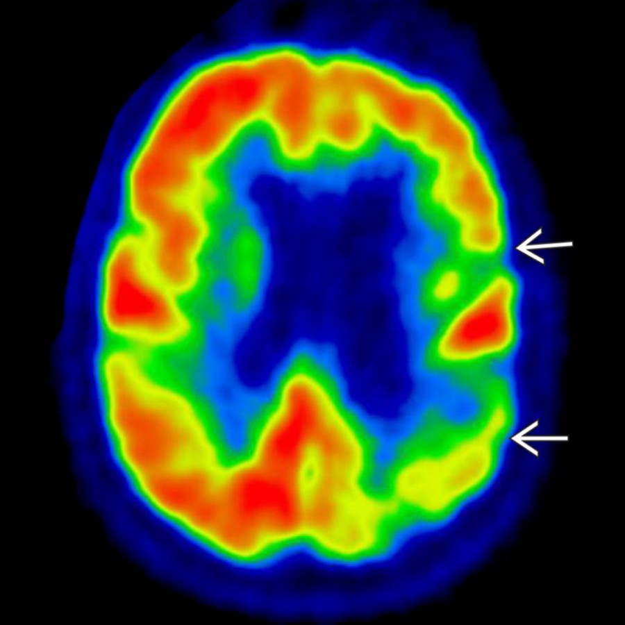 Axial F-18 FDG PET in a patient presenting with dementia shows more unilateral areas of hypometabolism  and globally decreased F-18 FDG uptake, also consistent with vascular dementia (VaD).