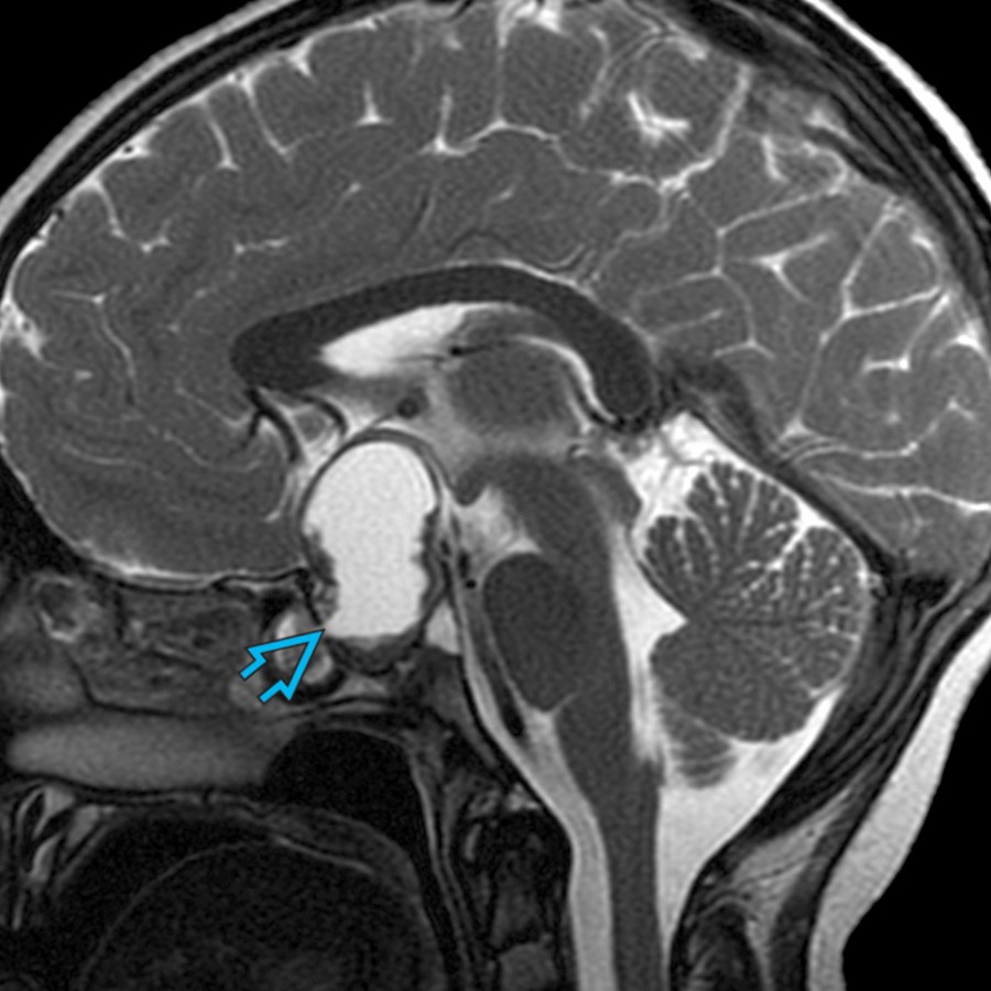 Sagittal T2WI MR shows a cystic sellar and suprasellar mass .Calcification and enhancement help differentiate craniopharyngioma from Rathke cleft cyst. Only 5% of craniopharyngiomas are purely intrasellar.
