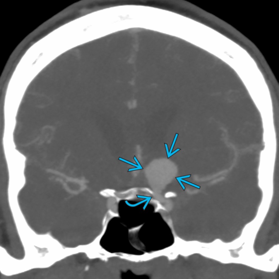 Coronal reformatted MIP image of a CT angiogram in the same setting shows that the SOL is actually a ruptured left terminal ICA  aneurysm . Patient underwent emergent aneurysm coiling.