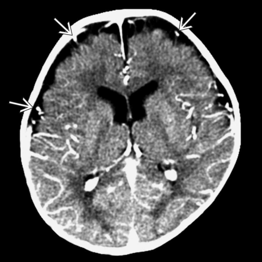 Axial CECT shows veins  traversing the enlarged SAS.