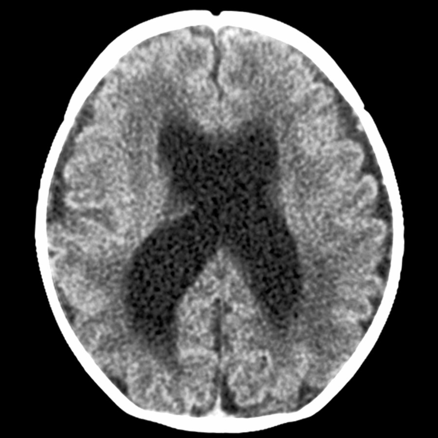 Axial NECT shows ventriculomegaly with rounded frontal horns out of proportion to sulcal enlargement.