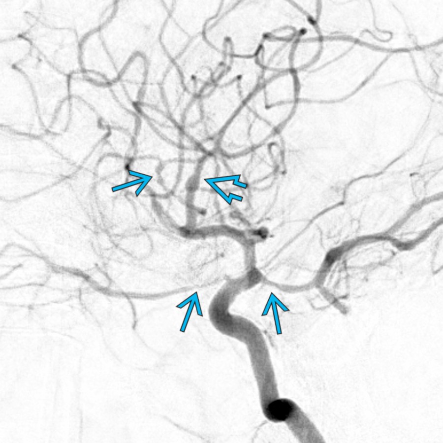 Lateral projection DSA from an internal carotid artery (ICA) injection in the same patient shows multifocal areas of medium vessel narrowing  and irregularity , a common feature of RCVS. The spectrum of underlying etiologies for childhood stroke is  diverse.