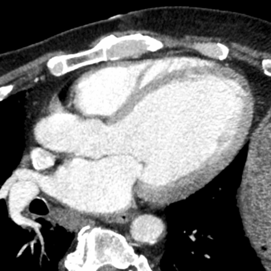 Diastolic phase LVOT CECT shows markedly dilated LV without aortic valve disease. This patient had depressed EF and densely calcified coronary arteries, indicating ischemic cardiomyopathy.