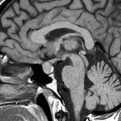 Sagittal T1 MR in a young, postpartum, lactating female shows an upwardly bulging pituitary gland  related to physiologic pituitary hyperplasia with the gland measuring almost 12 mm in height. Physiologic hyperplasia is most common in young, menstruating females and postpartum/lactating women.