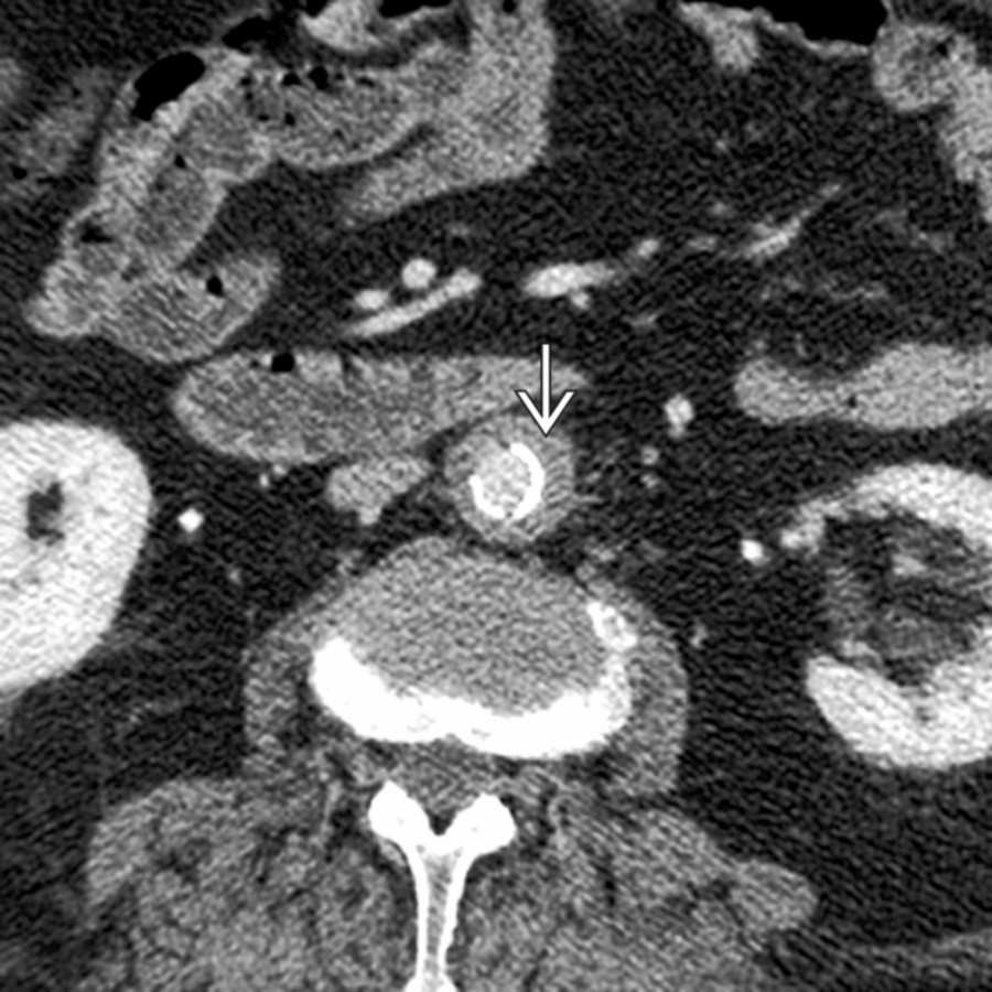 Axial CECT shows thickened aortic wall  with inner intimal calcifications. Although causing aortic narrowing, this may progress to aneurysmal dilation.