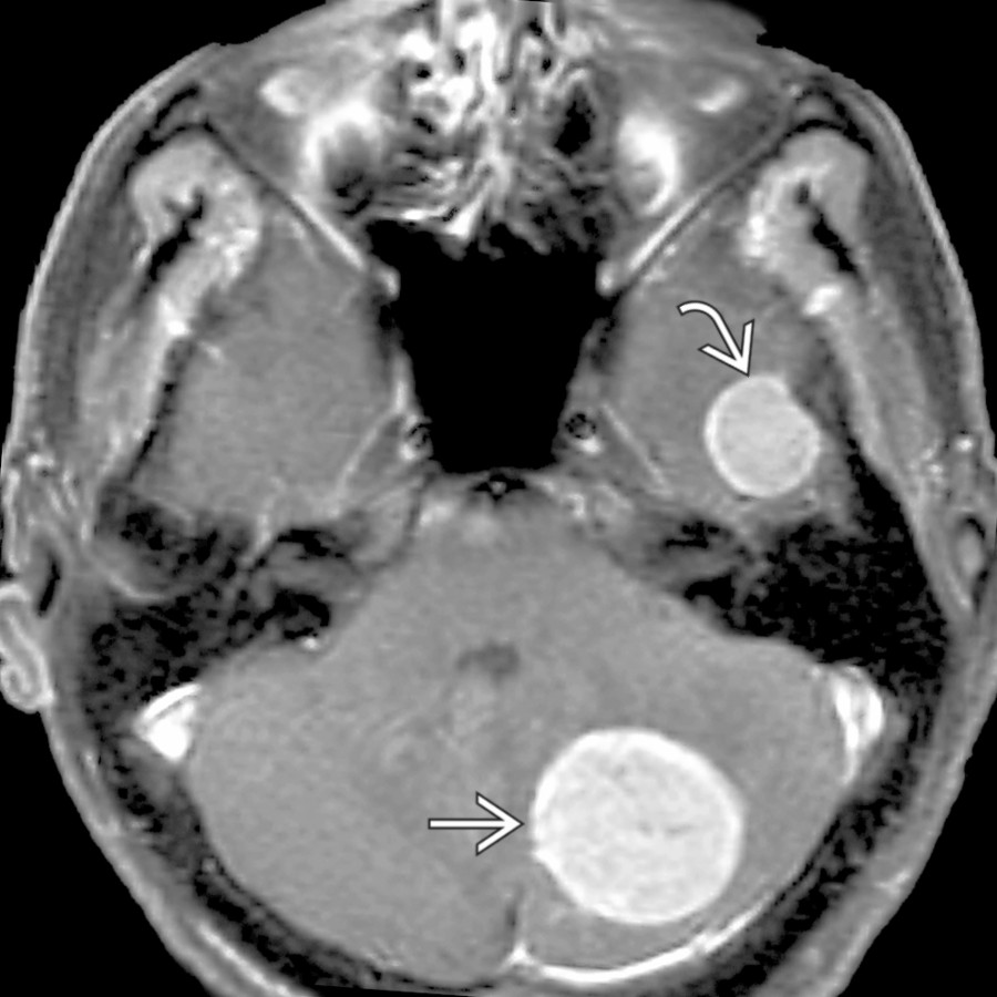 Axial T1 C+ FS MR shows a large, enhancing, cerebellar mass . A 2nd mass in the left temporal lobe  makes a diagnosis of metastases in a patient with known renal cell carcinoma easy.