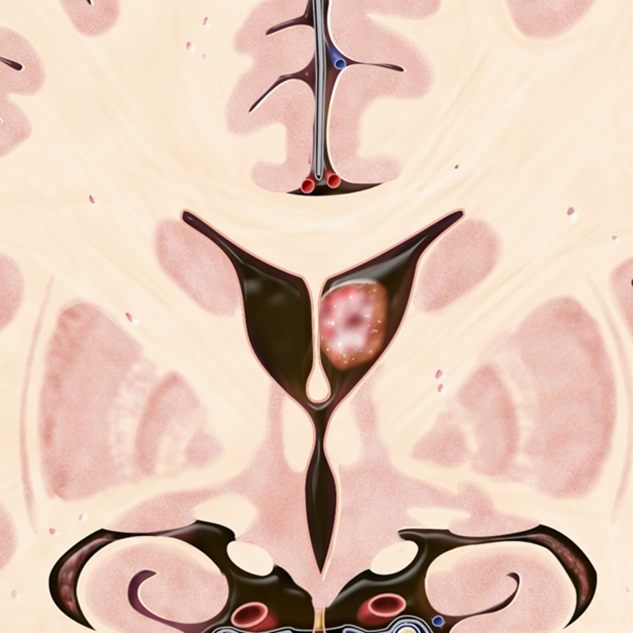 Coronal graphic shows a solid, well-circumscribed, intraventricular mass attached to the septum pellucidum with neither mass effect nor hydrocephalus. Subependymomas are typically asymptomatic, but they may cause hydrocephalus and increased intracranial pressure.