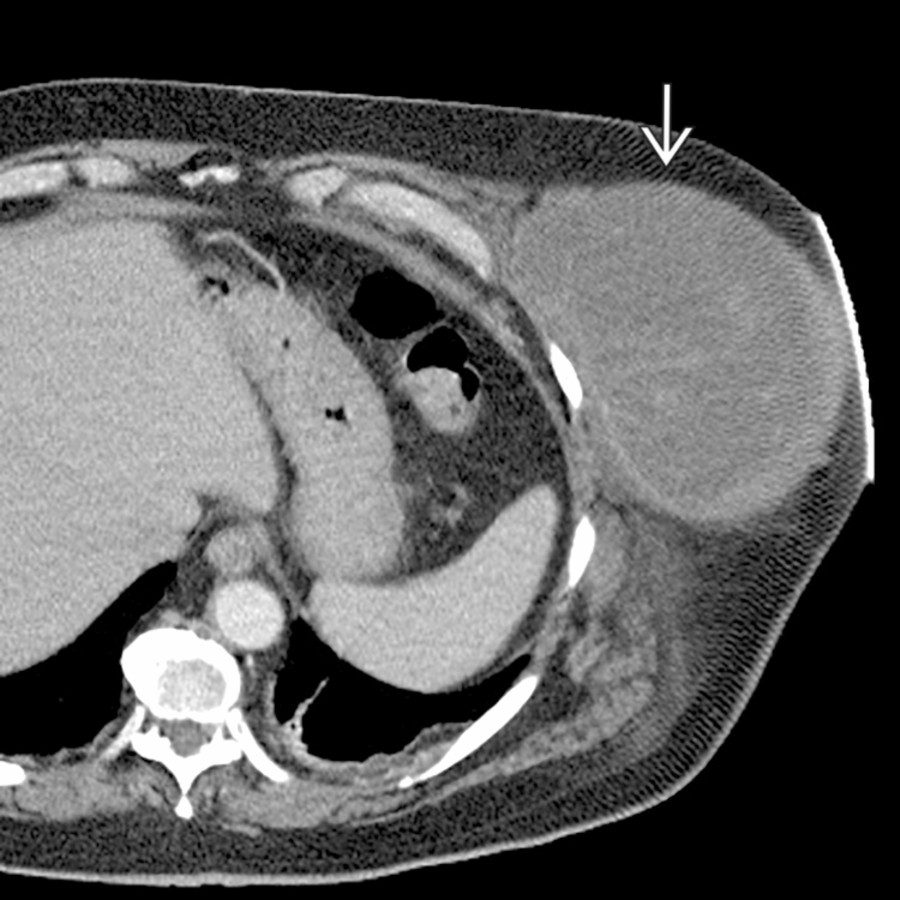 Axial CECT shows a large, rapidly growing mass    in the left anterior abdominal wall, representing a primary soft tissue sarcoma (malignant fibrous histiocytoma).