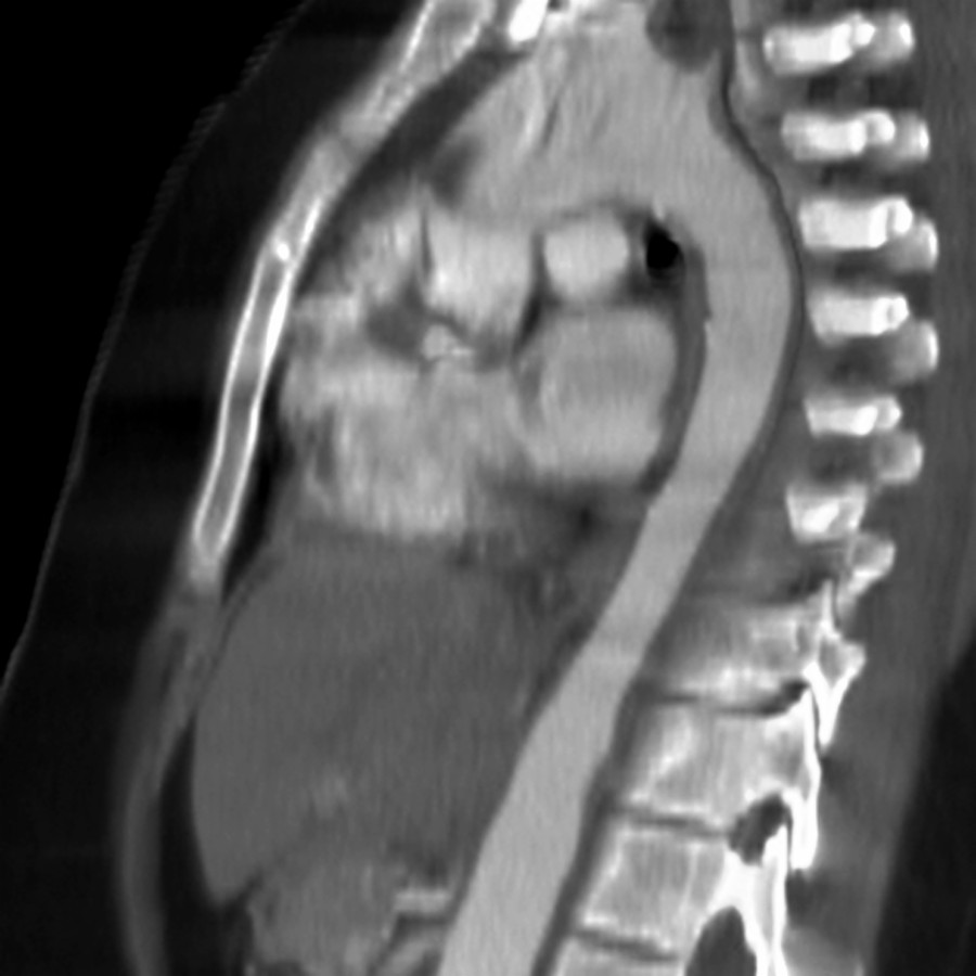 Sagittal oblique MIP CECT shows tapered narrowing of the mid-descending aorta with wall thickening in a patient with Takayasu arteritis. Note the absence of atherosclerotic disease.