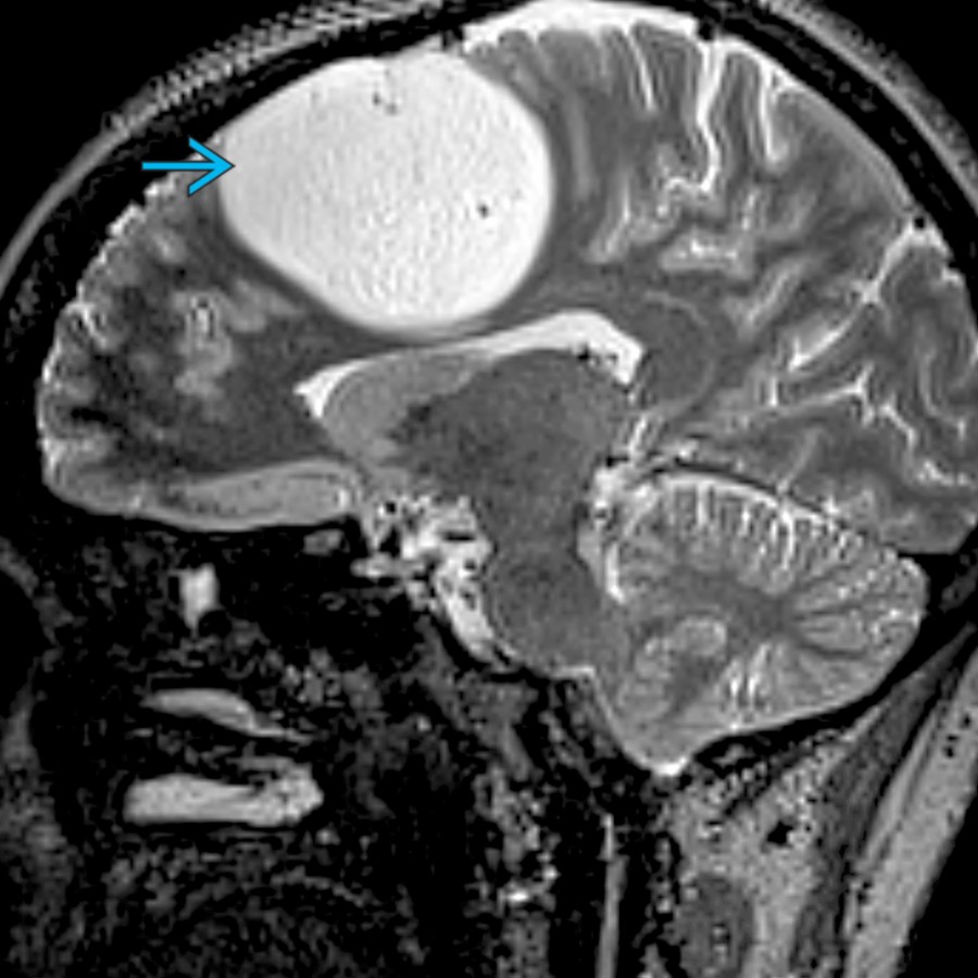 Sagittal T2 MR shows a well-circumscribed T2-hyperintense mass involving the posterior frontal cortex . This is a typical location and appearance for oligodendroglioma. 70-90% of patients with this tumor present with seizures due to its cortical nature.