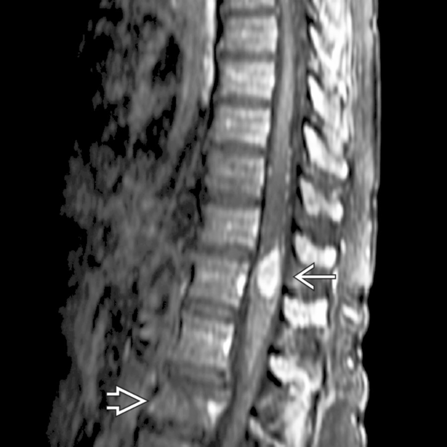 Sagittal T1 C+ FS MR shows focal intramedullary breast carcinoma metastasis enlarging the distal cord . Note vertebral metastasis  with a mild compression fracture.