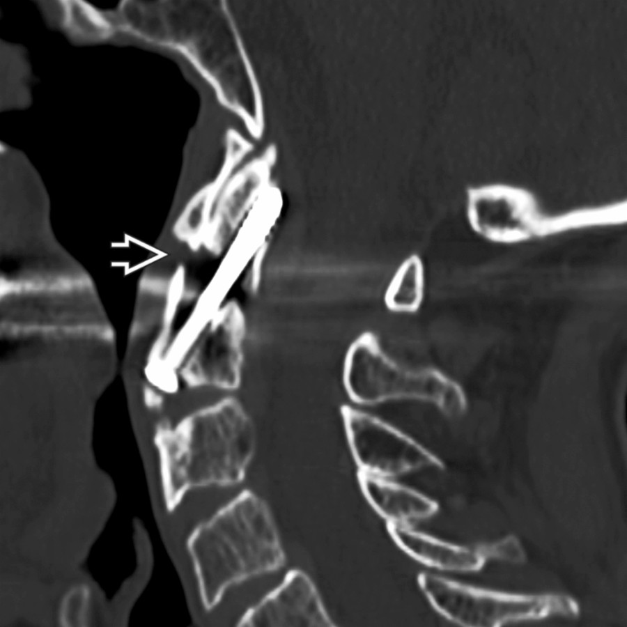 Sagittal bone CT shows atrophic odontoid fracture nonunion  after open reduction and internal fixation (ORIF). This usually is due not to infection but poor vascularity.