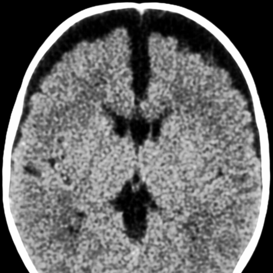 Axial NECT shows classic enlargement of SAS in this macrocephalic 5-month-old patient. Note the > 5-mm widening of the bifrontal craniocortical & anterior interhemispheric SAS.