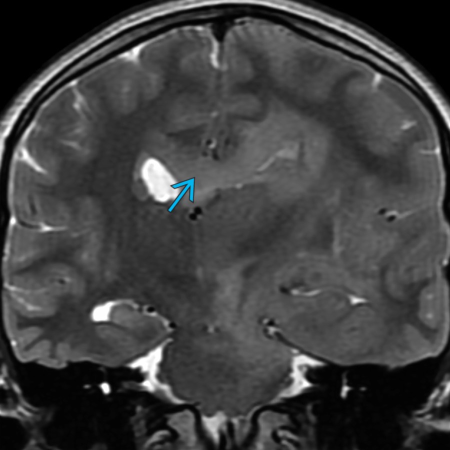 Coronal T2 MR in a 10 year old with glioblastoma shows mass-like infiltrative signal  crossing the midline through an expanded CC. Infiltrative high-grade glial neoplasms should be considered whenever such a finding is encountered, as they commonly spread along WM tracts, such as the CC.