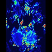 CBF map in the same patient demonstrates ↓ CBF in the right cerebellar hemisphere  consistent with acute CCD. CCD is caused by an interruption of the CPC fibers. As a result of ↓ afferent input, there is a ↓ in cerebellar metabolism, coupled with a ↓ in cerebellar perfusion.