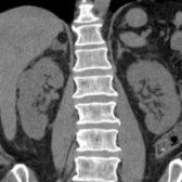 Coronal NECT in a 71-year-old man with left flank pain shows an incidental collision tumor composed of a myelolipoma  and an adenoma .
