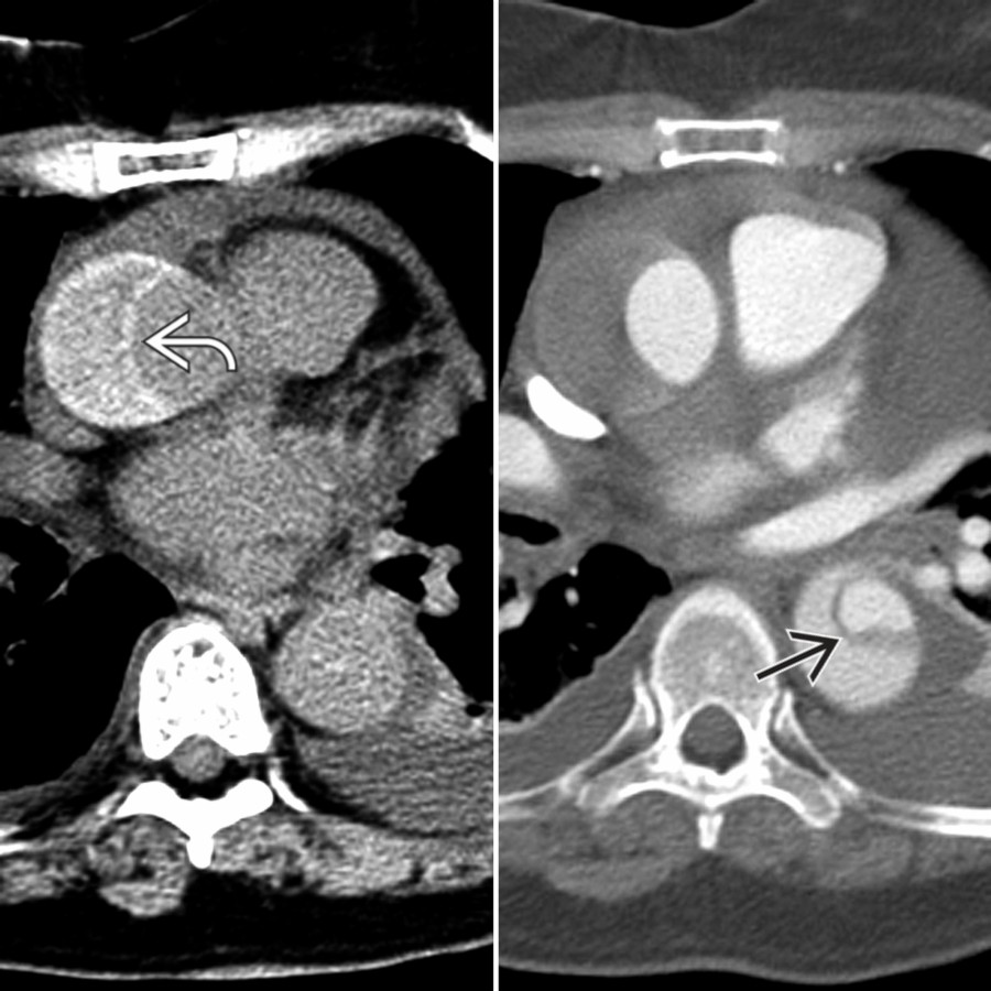 Axial chest NECT and CTA in a patient with type A IMH  show a coexistent descending thoracic aortic dissection .