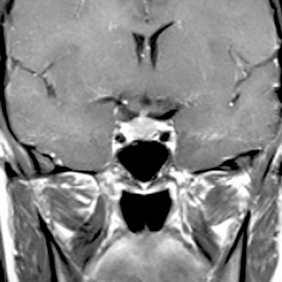 Coronal T1 C+ MR shows an enlarged pituitary gland in this asymptomatic 28-year-woman. Follow-up scan 1 year later was normal.