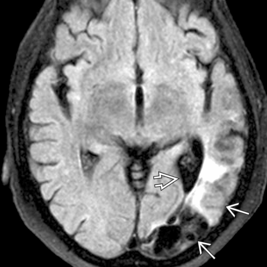 Axial FLAIR MR demonstrates a left posterior MCA encephalomalacia  resulting in mild ex-vacuo dilatation of the left atrium .