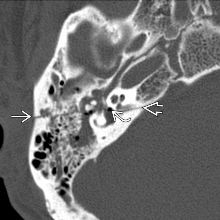 Axial bone CT shows an oblique T-bone fracture  traversing the oval window and extending to the IAC area . Notice the air bubble (pneumolabyrinth) along the anterior margin of the vestibule .