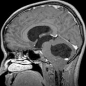 Sagittal T1 C+ MR shows a cystic mass with an enhancing nodule , consistent with hemangioblastoma, pushing the tonsils inferiorly through the foramen magnum . Note effaced 4th ventricle , enlarged foramen of Monro , and enlarged 3rd  and lateral  ventricles, consistent with obstructive hydrocephalus.