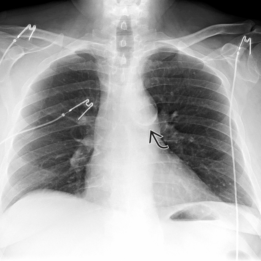 PA chest radiograph in an asymptomatic patient with CTAI and a pseudoaneurysm shows curvilinear calcifications  along the inferior aspect of the aortic arch.