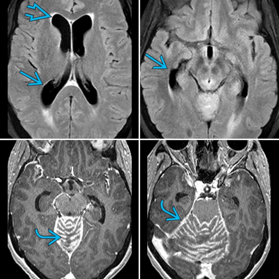 Axial FLAIR MR images (top) in a patient with breast carcinoma leptomeningeal metastasis shows dilatation of the ventricles    with mild periventricular interstitial edema . Axial T1 C+ MR (bottom) shows extensive leptomeningeal enhancement  along the cerebellar folia.