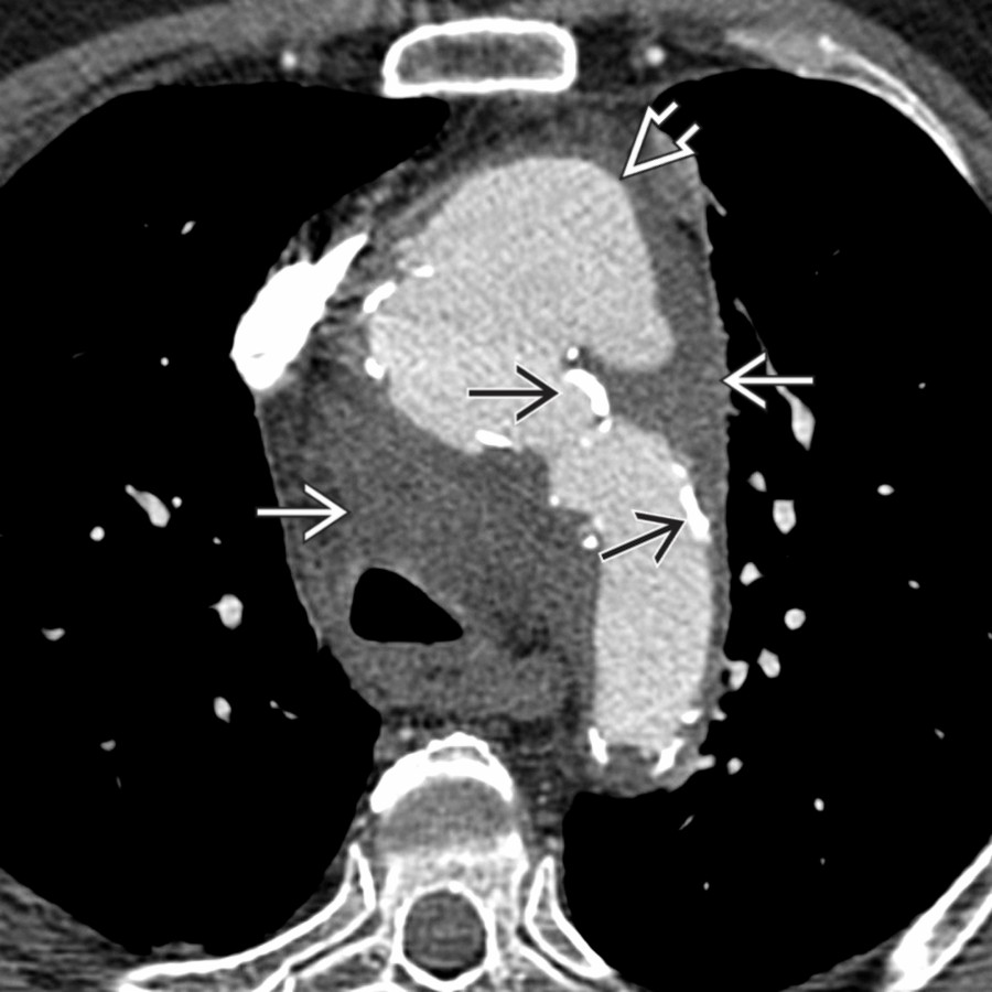 Axial CTA of the chest in the same patient shows a large ulceration along the anterior proximal aortic arch  with surrounding mediastinal hemorrhage  and extensive atherosclerosis .