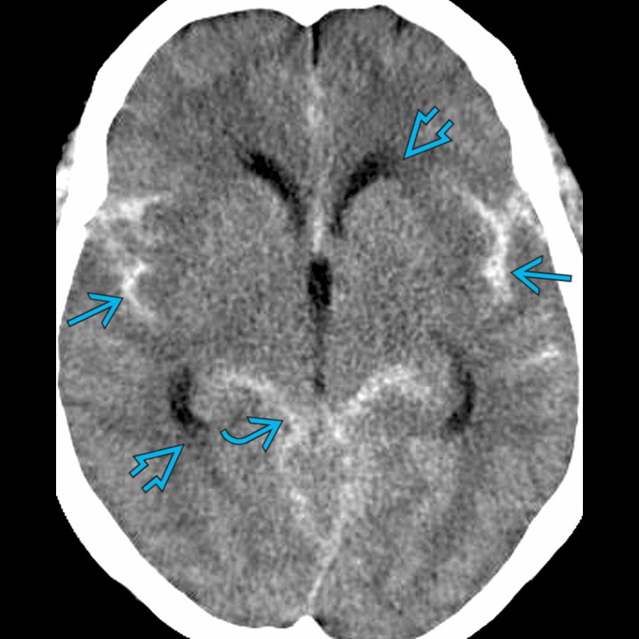 Axial NECT shows acute subarachnoid hemorrhage in the basal cisterns  and sylvian fissures . There is early extraventricular obstructive hydrocephalus with mild periventricular hypodensity  due to interstitial edema.