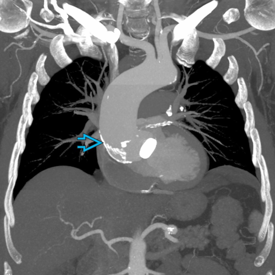 Coronal CECT MIP in the same patient shows the AA atherosclerosis . The AA is aneurysmal with a maximum diameter of 5 cm.