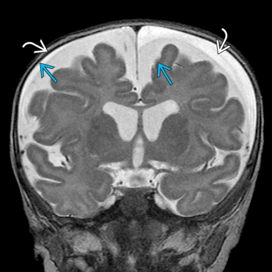 Coronal T2 MR in the same patient shows symmetrically enlarged SAS  as well as small, bilateral, nonhemorrhagic subdural fluid collections . Small, subdural fluid collections are seen in ~ 4% of patients with enlarged SAS.