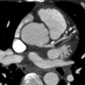 Axial oblique CECT MIP shows discrete calcifications in a linear arrangement  in a patient with LAD atherosclerosis. Note the presence of noncalcified plaque .