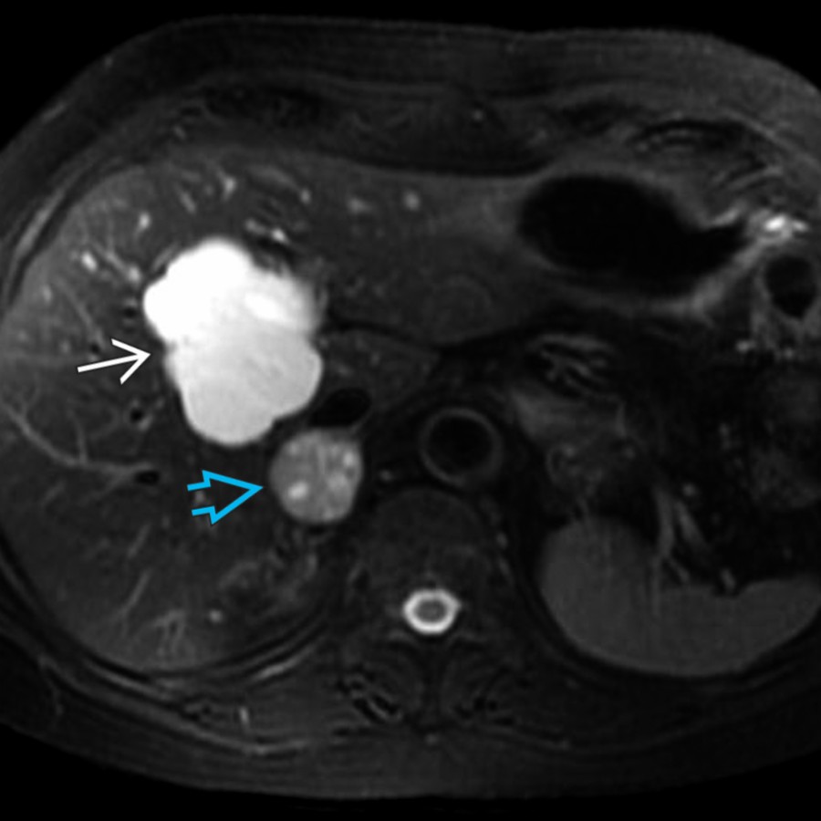 Axial T2 FS MR in an 80-year-old man with sporadic pheochromocytoma shows a rounded right adrenal mass  with heterogeneous signal. Sporadic pheochromocytoma occurs more often in older patients. Note incidental hepatic cyst .