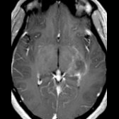 Axial T1 C+ MR in the same patient shows patchy enhancement  with blurred margins ("cloud-like" enhancement). NMO- IgG antibody in serum was positive in this patient. This pattern of enhancement has been reported as relatively specific for NMO.